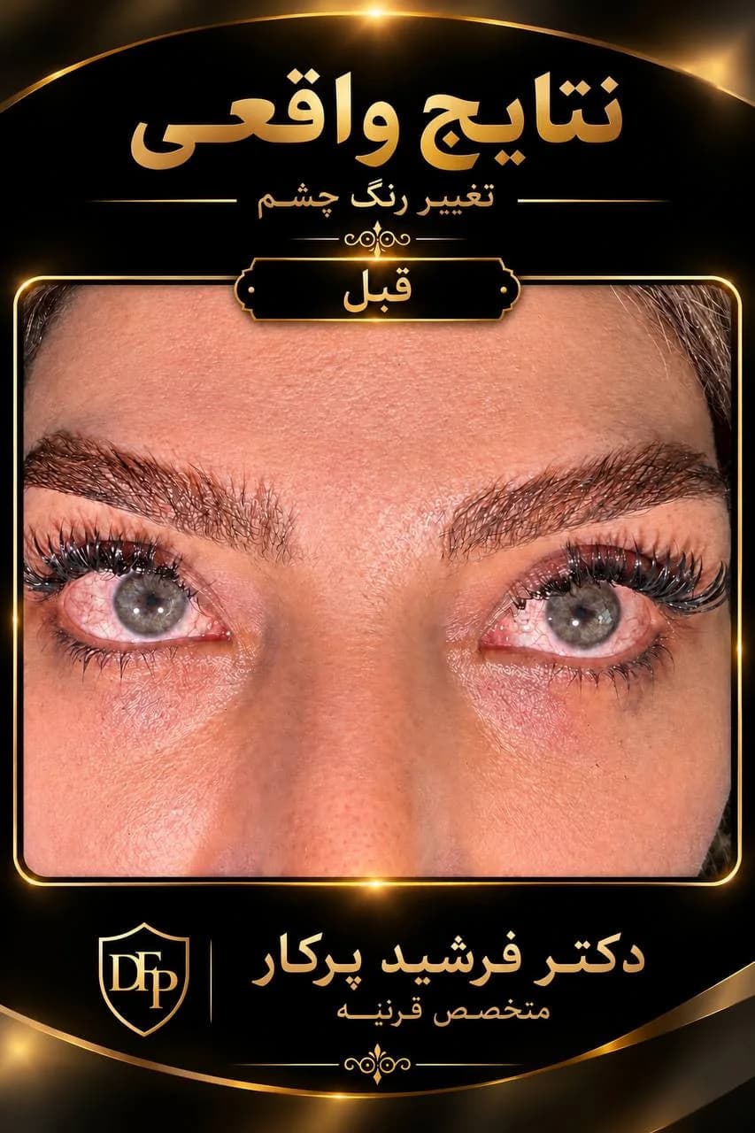 eye-color-change-before-labeled-gray-eyes-10-dr-farshid-porkar.webp