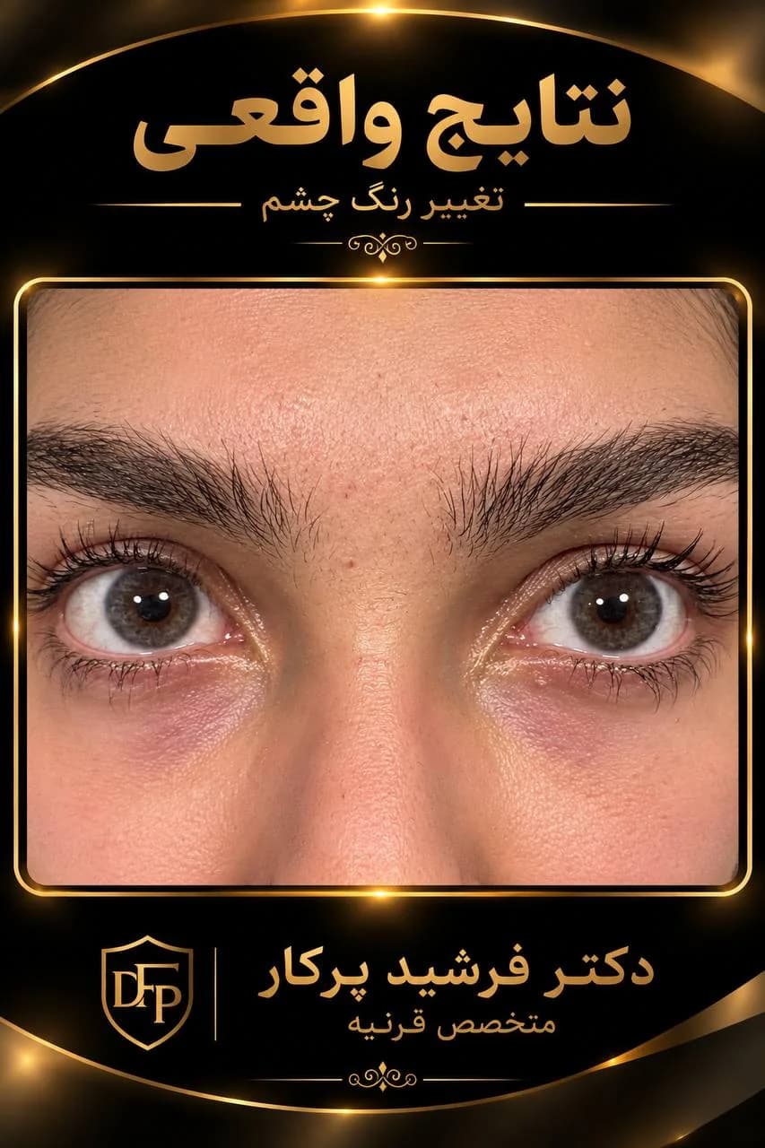eye-color-change-gallery-gray-brown-eyes-08-dr-farshid-porkar.webp