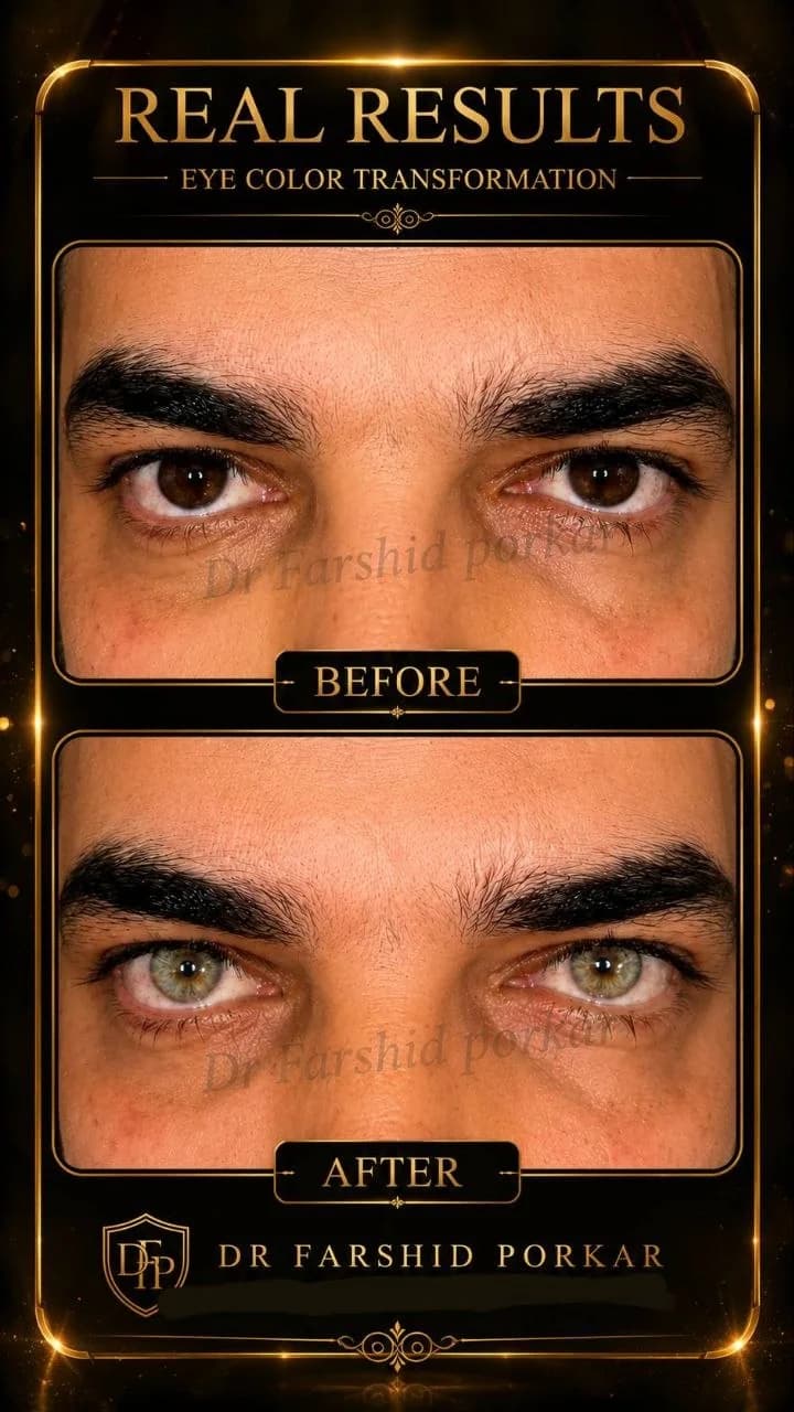 eye-color-change-before-after-brown-to-green-hazel-04-dr-farshid-porkar.webp
