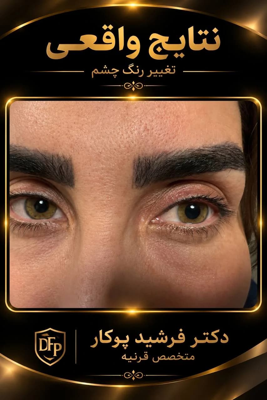 eye-color-change-gallery-hazel-green-eyes-06-dr-farshid-porkar.webp