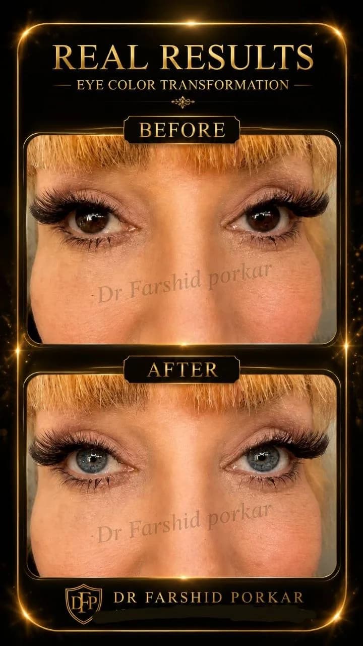 eye-color-change-before-after-brown-to-gray-01-dr-farshid-porkar.webp
