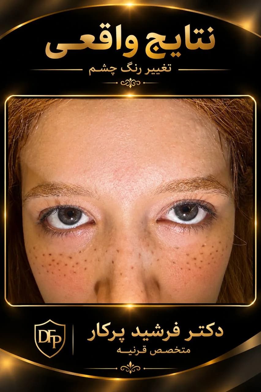 eye-color-change-gallery-gray-eyes-freckles-09-dr-farshid-porkar.webp