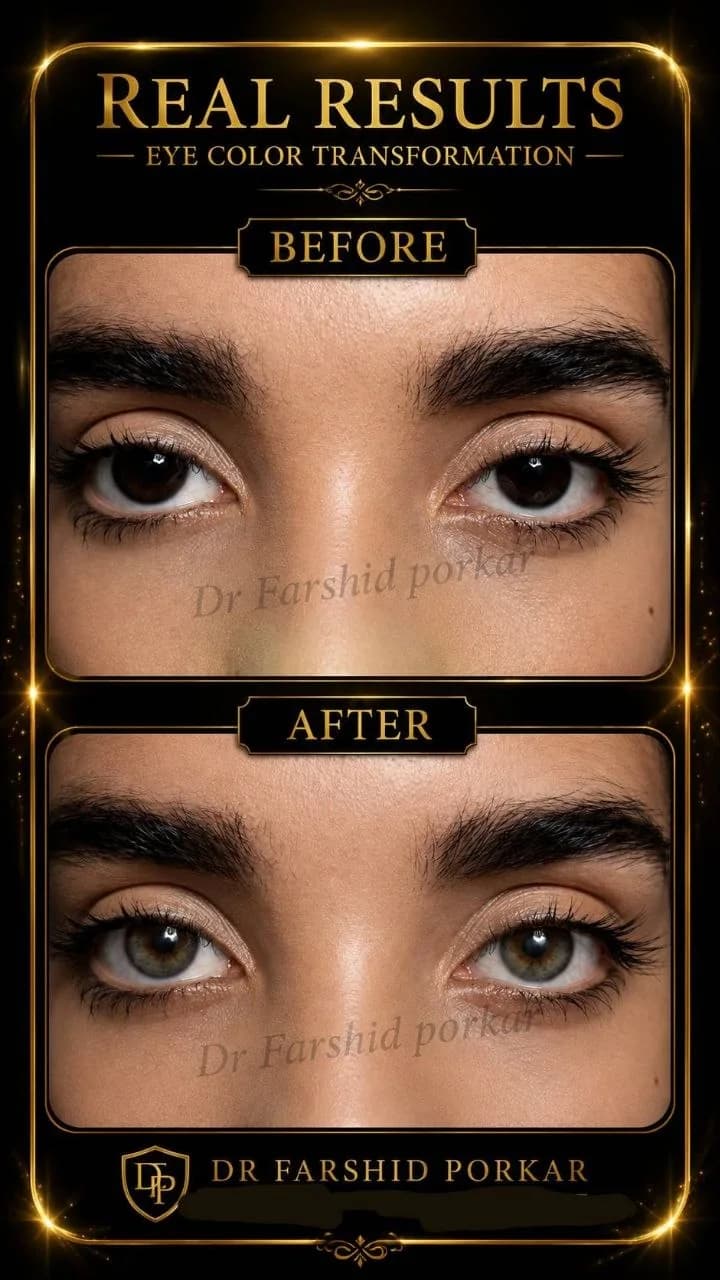 eye-color-change-before-after-dark-brown-to-gray-03-dr-farshid-porkar.webp
