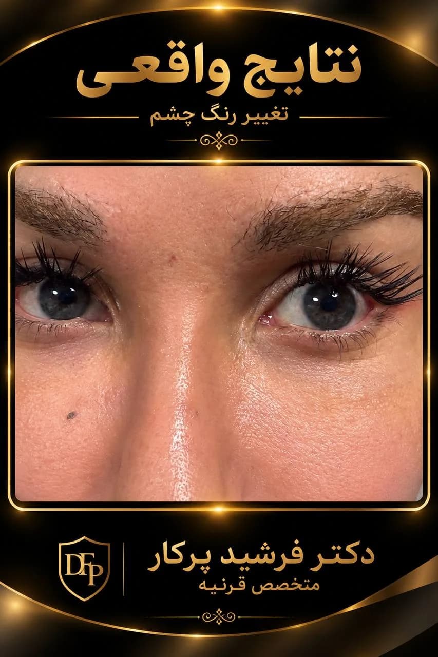 eye-color-change-gallery-light-gray-eyes-07-dr-farshid-porkar.webp