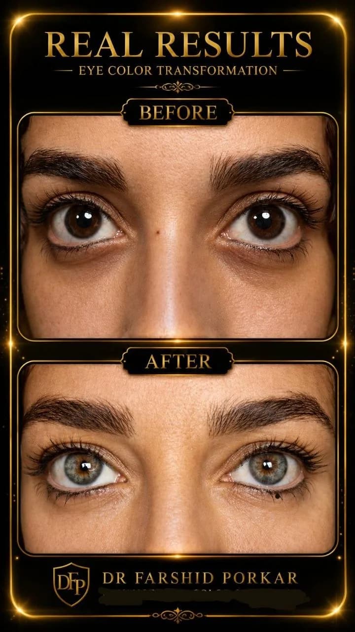 eye-color-change-before-after-brown-to-gray-hazel-05-dr-farshid-porkar.webp