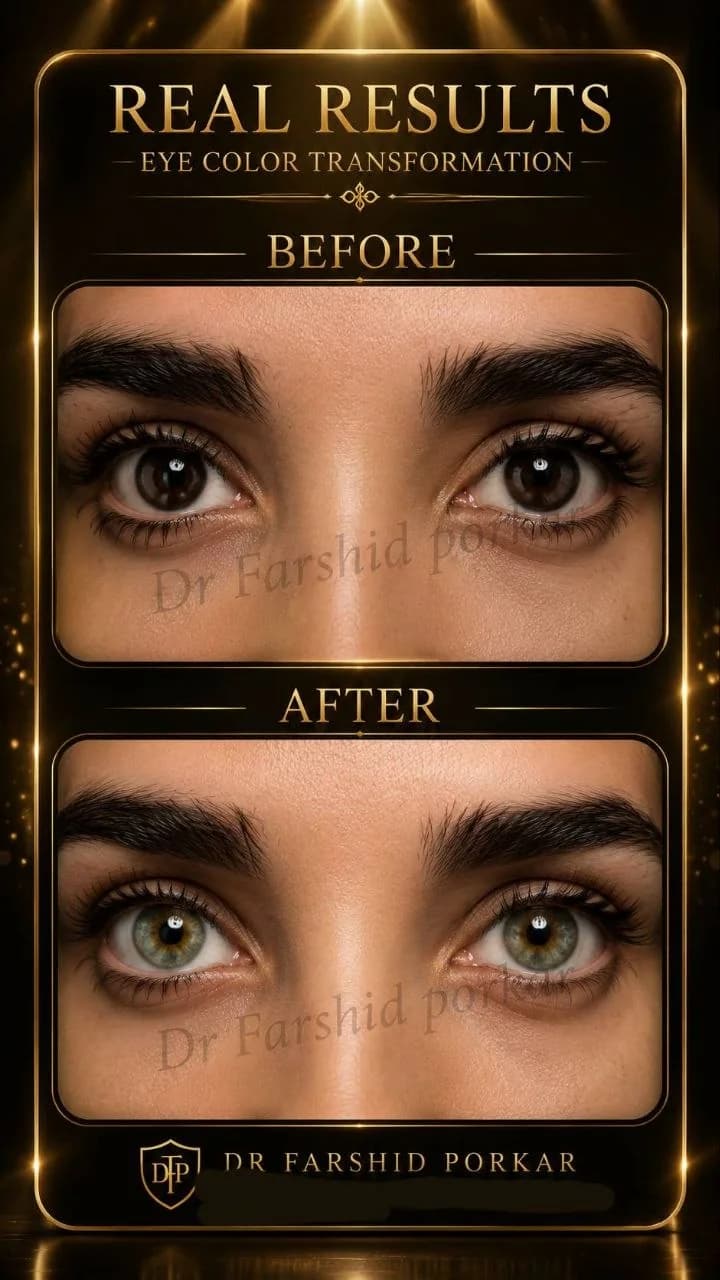 eye-color-change-before-after-brown-to-hazel-green-02-dr-farshid-porkar.webp